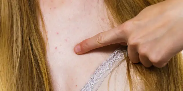 Dłoń wskazująca na pryszcze na dekolcie i szyi.
