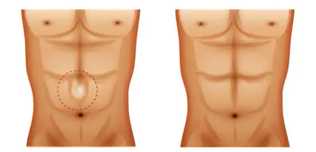 Jakie ćwiczenia przy przepuklinie pępkowej mogą pomóc uniknąć bólu?