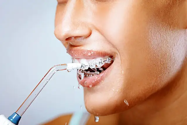 Irygator skutecznie usuwa kamień nazębny, zwłaszcza wokół aparatu ortodontycznego. Woda rozpryskuje się, docierając do trudno dostępnych miejsc.