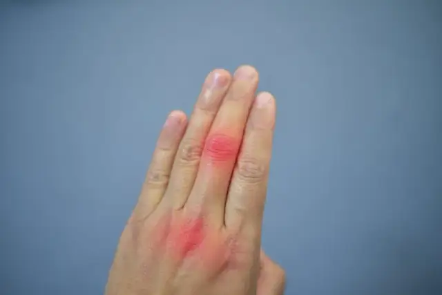 Kwas moczowy jakie badanie: jak przygotować się i co oznacza wynik