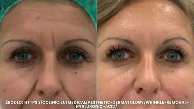 Botoks czy kwas hialuronowy na lwią zmarszczkę? Porównanie