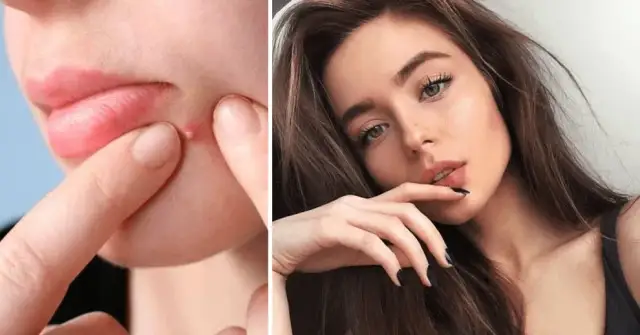 Jak wysuszyć pryszcza szybko i skutecznie - sprawdzone metody