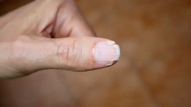 Widok z bliska na kciuk z widocznymi, rozdwajającymi się paznokciami, które mają białe, łuszczące się warstwy.