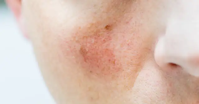 Zaczerwienienie po wyciśnięciu pryszcza: Szybka ulga dla skóry