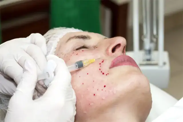 Mikrodermabrazja czy mezoterapia? Porównanie, efekty i ceny