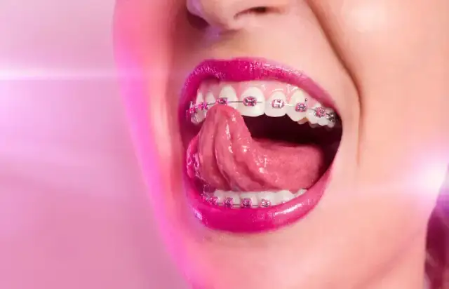 Jak wygląda aparat na zęby? Przewodnik po typach i estetyce