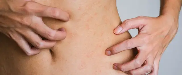 Alergia na kurz: objawy skórne, jak rozpoznać i leczyć