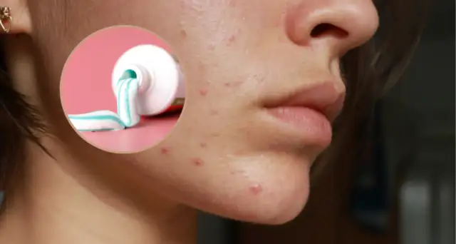 Jak szybko usunąć pryszcz? Skuteczne metody na natychmiastowe efekty