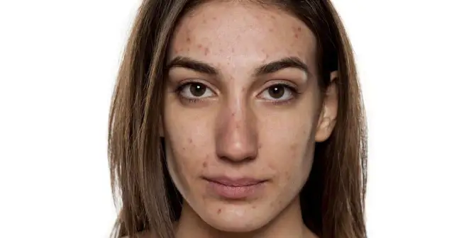 Skuteczne sposoby na czerwone plamy po pryszczach, które zadziałają