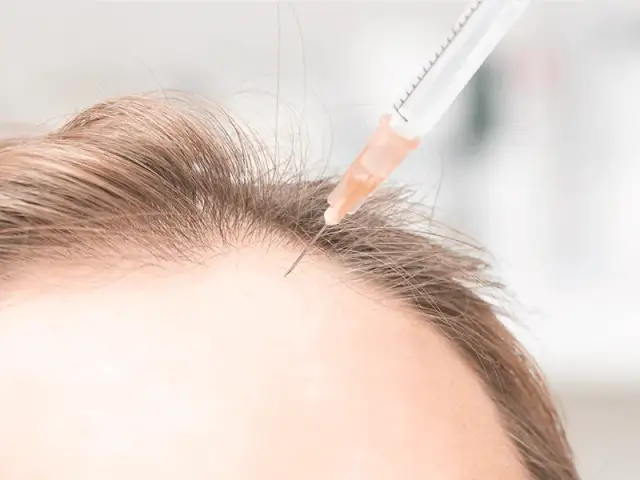 Tiroides y caída de pelo: cómo evitar la pérdida y recuperar tu cabello