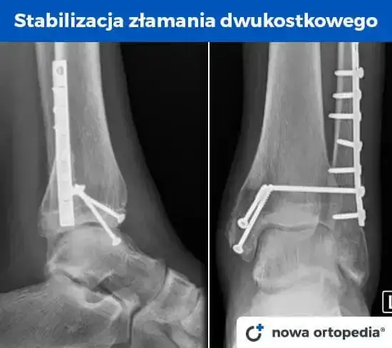 Złamana kość? Ile trwa rehabilitacja i jak wrócić do formy?
