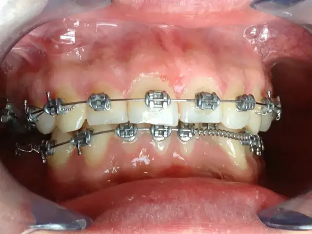 Jak wygląda stały aparat na zęby? Odkryj różnice i estetykę