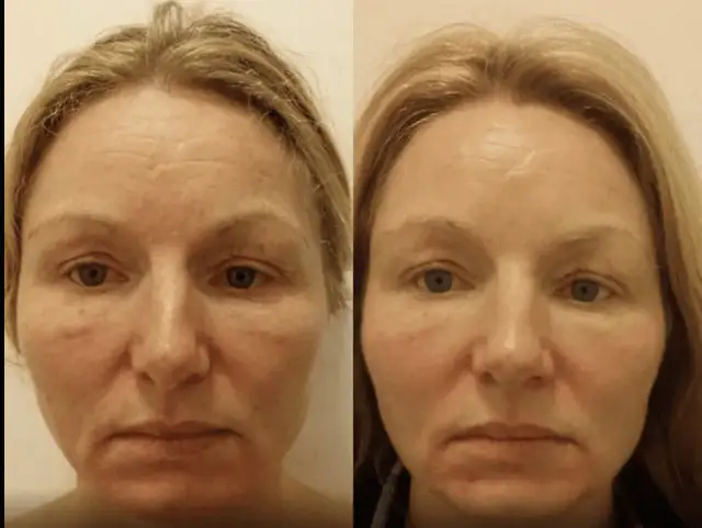 Masaż Kobido: Jak często? Intensywna seria i podtrzymanie efektów