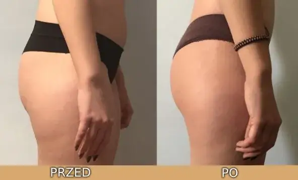 Drenaż limfatyczny: efekty od razu czy po serii? Sprawdź!