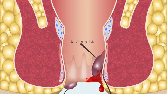 Ilustracja anatomiczna hemoroidów wewnętrznych z krwawieniem.