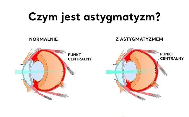 Astygmatyzm: Wyleczyć czy skorygować? Przewodnik po metodach.