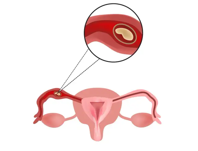 Ciąża pozamaciczna: Co to jest? Objawy, diagnoza, leczenie, płodność