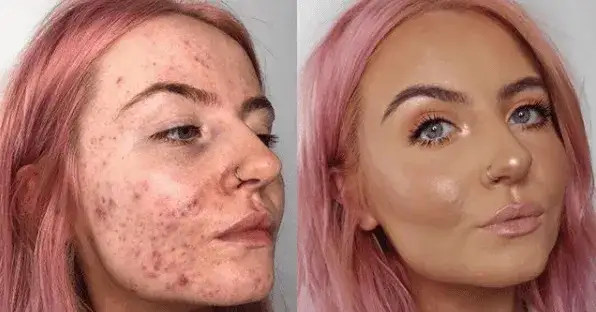 Jaki podkład do cery trądzikowej? Odkryj idealne rozwiązania dla Twojej skóry