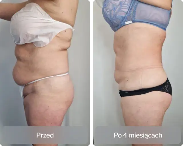 Liposukcja ultradźwiękowa co to? Fakty, które musisz znać przed zabiegiem