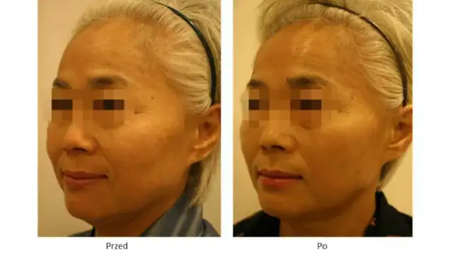 Co lepsze: nici PDO czy kwas hialuronowy? Porównanie efektów i korzyści