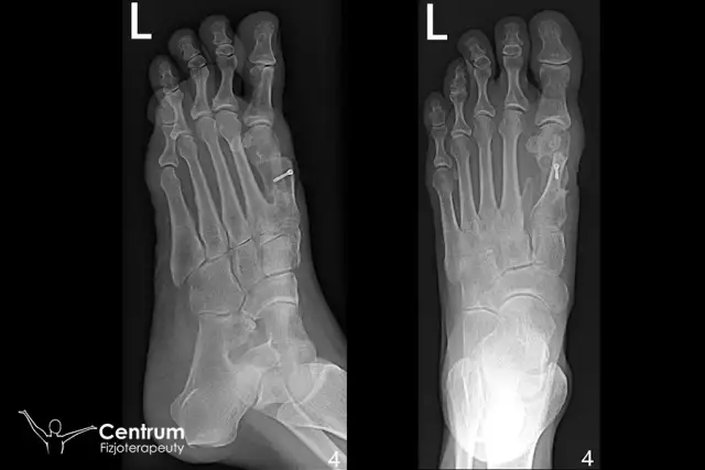 Rekonwalescencja po operacji haluksa: Krok po kroku do pełnej sprawności