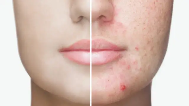 Pryszcze: Co naprawdę działa? Skuteczny plan pielęgnacji i leczenia