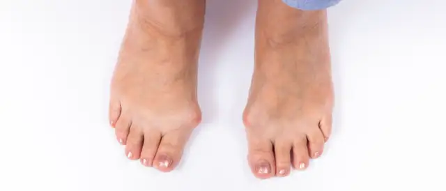 Dlaczego robią się haluksy? Odkryj przyczyny i jak ich unikać