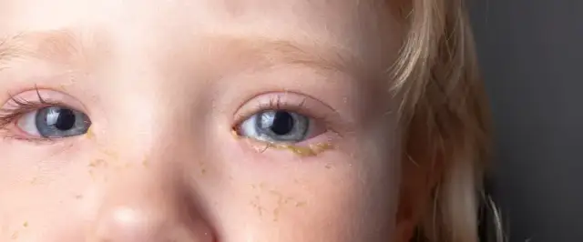 Ropiejące oczko u niemowlaka: Co robić, czego unikać i kiedy do lekarza