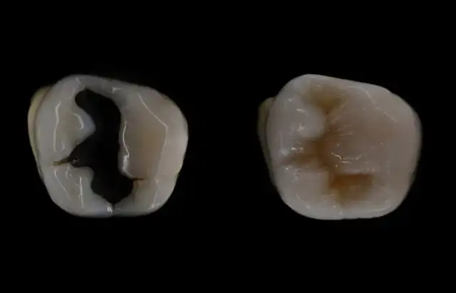 Ile kosztuje plomba na NFZ? Sprawdź ukryte koszty i różnice