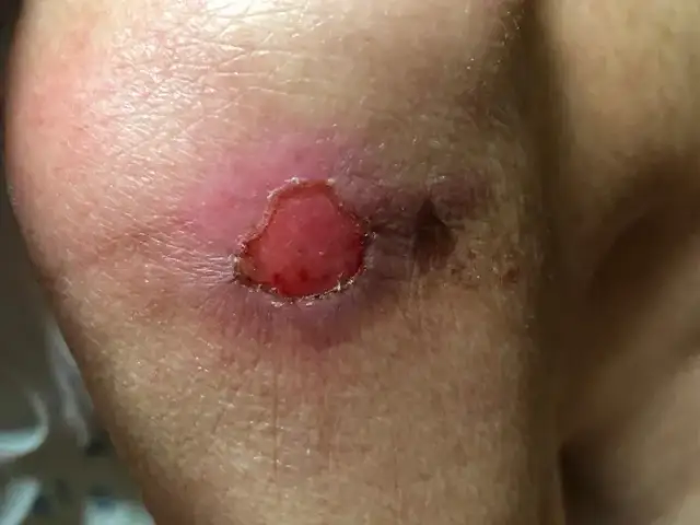 Odleżyny u osób starszych: Jak skutecznie leczyć i zapobiegać?