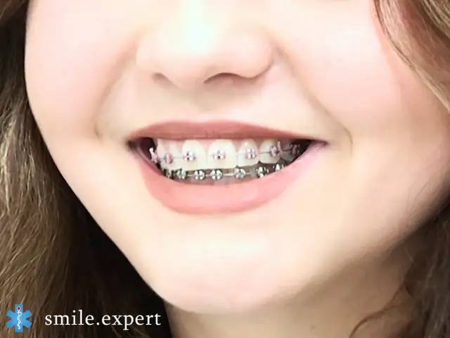 Ile trwa leczenie ortodontyczne? Poznaj realny czas i czynniki