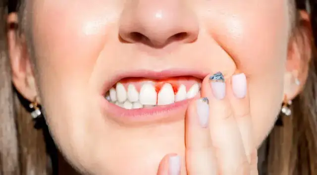 Krwawiące dziąsła? Zatamuj krwotok w 3 krokach i poznaj przyczyny