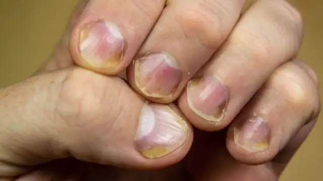 Paznokcie a zdrowie: Co mówią o Tobie? Sprawdź objawy i sygnały!