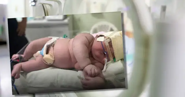 Noworodek w pieluszce leżący na poduszce, z sondą i bandażem na głowie.