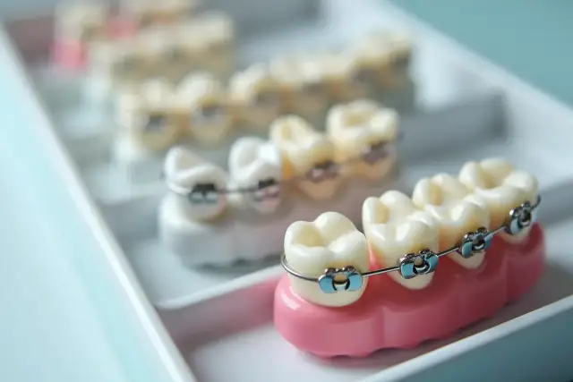 Modele zębów z aparatami ortodontycznymi w różnych kolorach, ułożone w białej tacce.