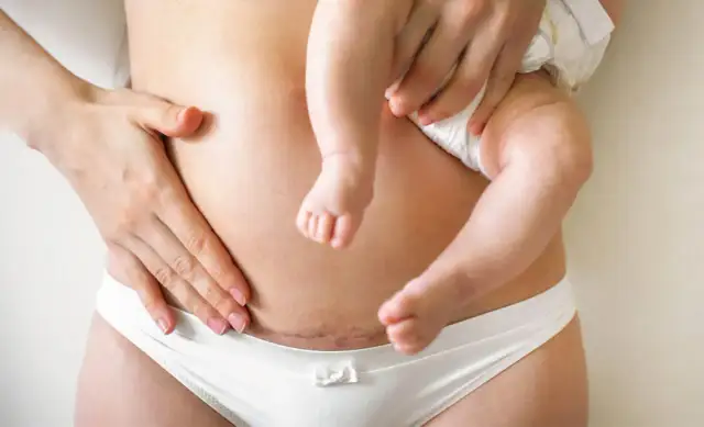 Brzuch po cesarce z widoczną blizną. Dowiedz się, jak usunąć zrosty po cesarce i odzyskać formę.