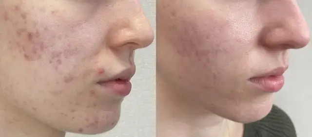 Jak wygląda zapchana cera? Objawy i skuteczne metody leczenia