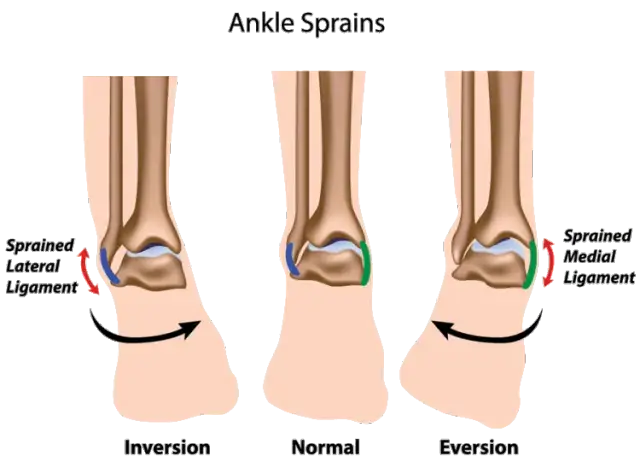 Skręcona kostka jak długo trwa leczenie i powrót do sprawności