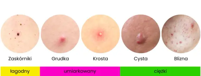 Jak pozbyć się pryszczy? Kompleksowy przewodnik po leczeniu