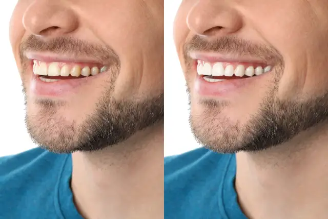 Wybielanie zębów w tydzień: Bezpieczne metody i realne efekty.