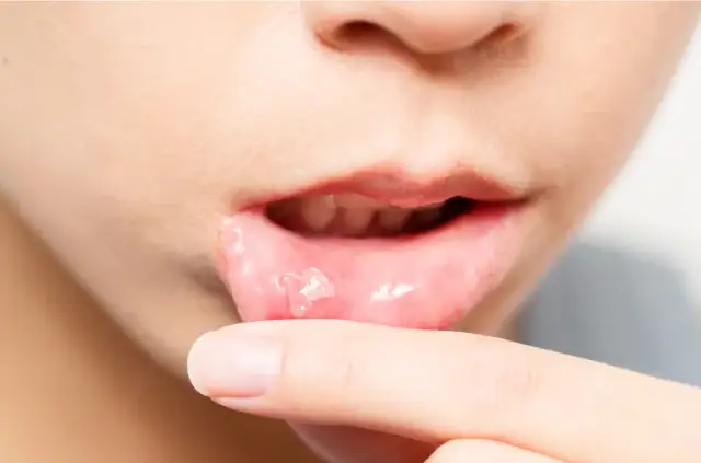 Skuteczne sposoby na smarowanie nadżerek w jamie ustnej, które przynoszą ulgę