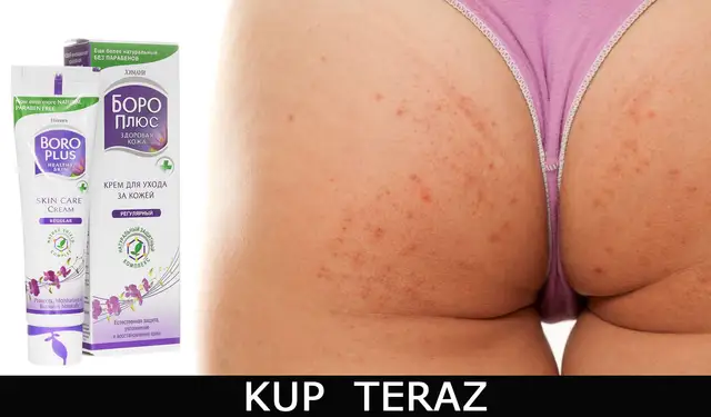 Pryszcze na pupie: Jak się pozbyć i mieć gładką skórę?