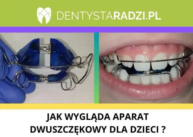 Aparat ortodontyczny z NFZ: Tylko dla dzieci? Prawda o refundacji