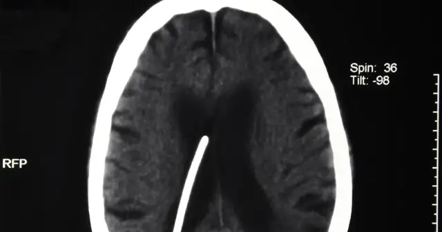 Wodogłowie u dorosłych objawy – jak je rozpoznać i uniknąć powikłań