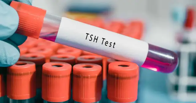 Ręka w niebieskiej rękawiczce trzyma probówkę z napisem "TSH Test". W tle widać rząd innych probówek z pomarańczowymi nakrętkami. Wynik TSH powyżej 100 może wskazywać na niedoczynność tarczycy.