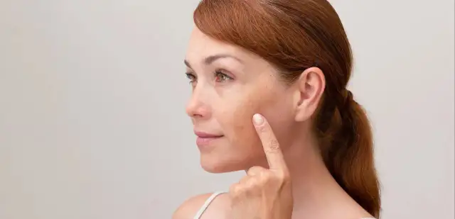 Skuteczne metody na przebarwienia po pryszczach, które naprawdę działają