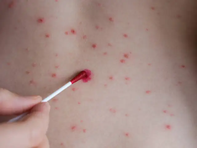 Leki na rozwolnienie: Co wybrać? Przewodnik po skutecznych opcjach