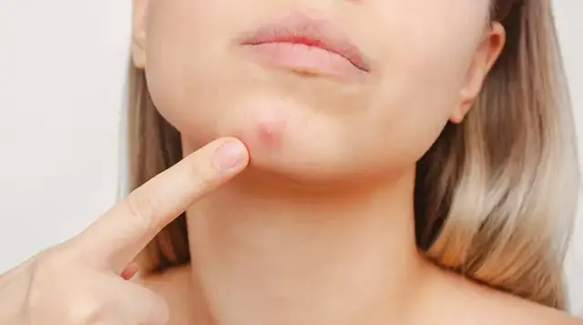 Jak szybko pozbyć się pryszcza? Bez wyciskania i blizn!