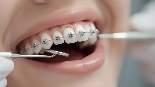 Jak wygląda aparat na zęby? Od klasyki po niewidoczne opcje