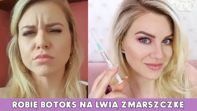 Ile kosztuje botoks na lwią zmarszczkę? Ceny w Polsce i ważne informacje